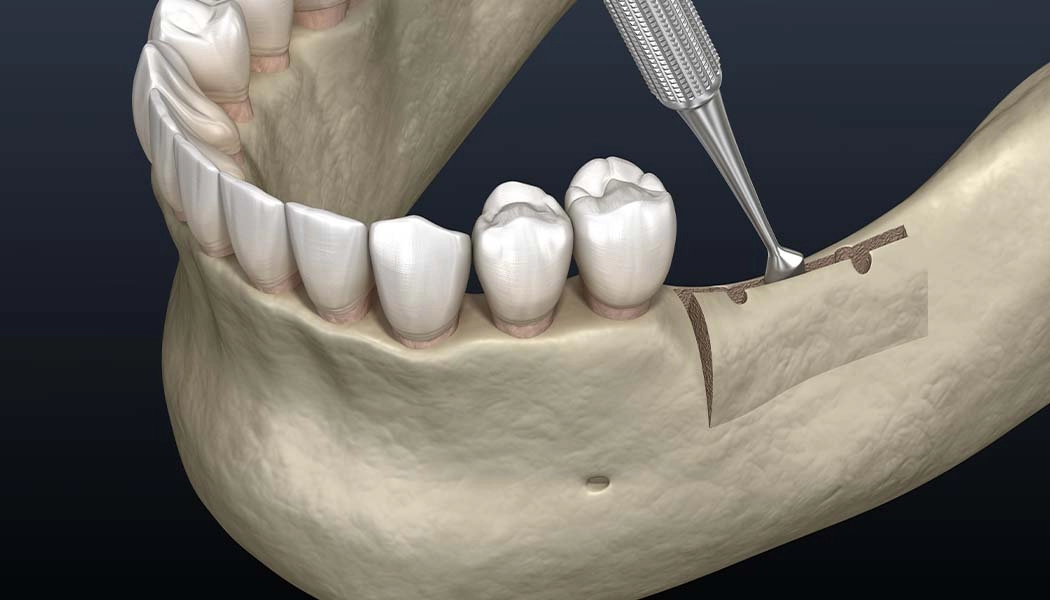 фото:Лечение атрофии кости на нижней челюсти::Лечение атрофии кости остеопластикой альвеолярного гребня