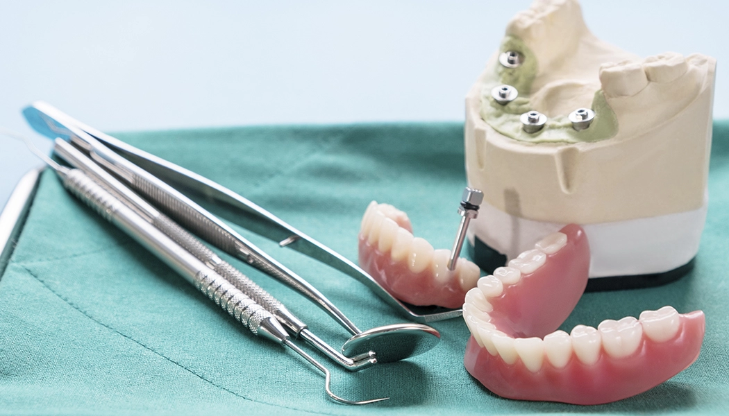 фото:Временное протезирование нижней челюсти::Протез на нижнюю челюсть на 4 импланта