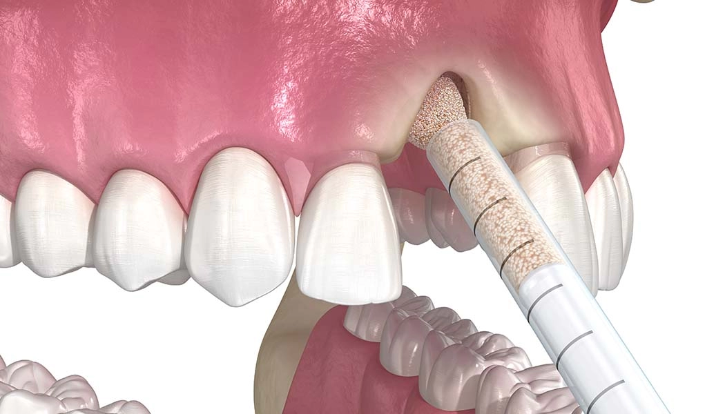 фото:Направленная регенерация костной ткани челюсти::НРК при атрофии после потери зубов