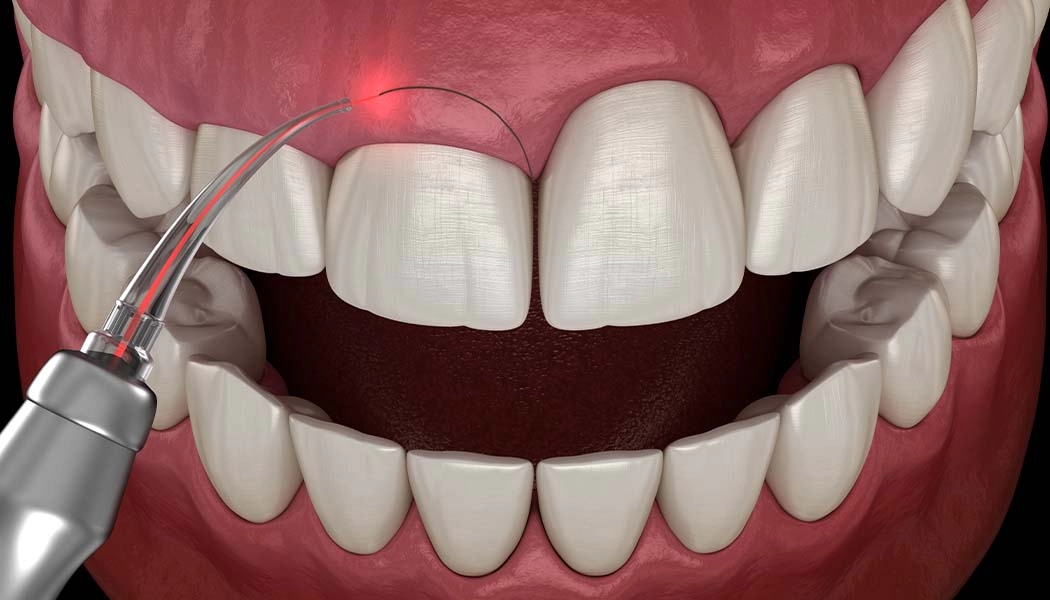 фото:Пластика десны лазером::Иссечение десны стоматологическим лазером