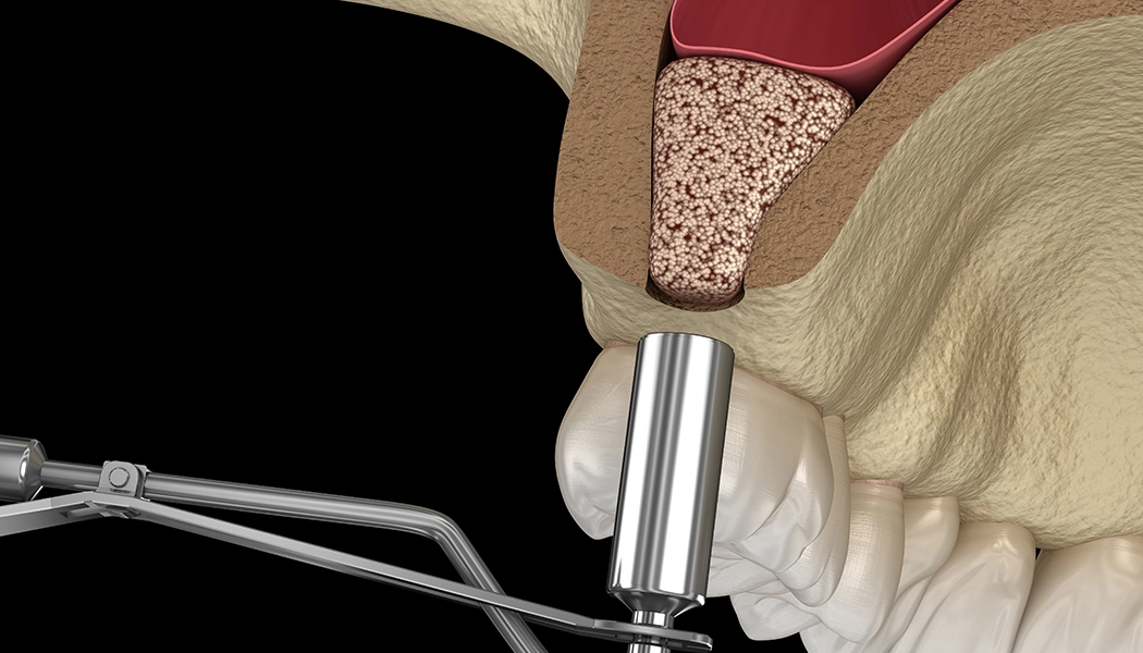 фото:Открытый синус-лифтинг для наращивания кости в области одного зуба::Операция по закрытому синус-лифтингу