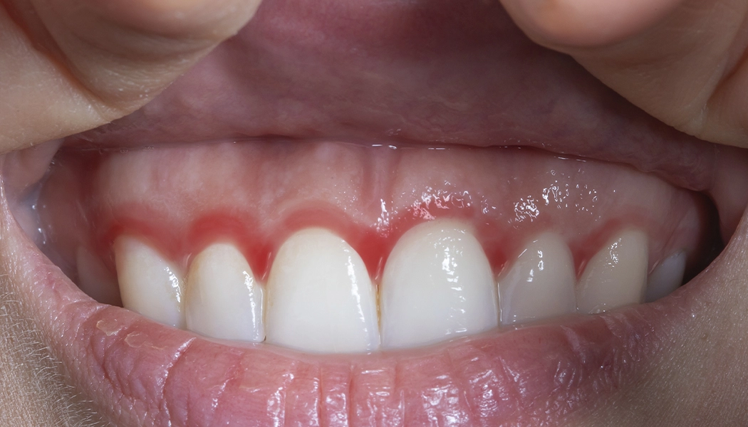 фото:Лечении стоматита, гингивита, герпеса лазером::Лечение дёсен лазером