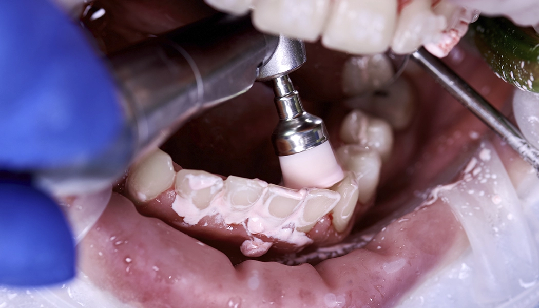 фото:Шлифовка зубов у стоматолога::Полировкка и шлифовка зубной эмали